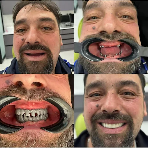 Trasformazione dentale paziente 1 - Prima e dopo
