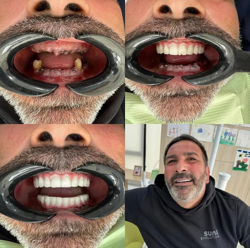 Trasformazione dentale paziente 4 - Prima e dopo